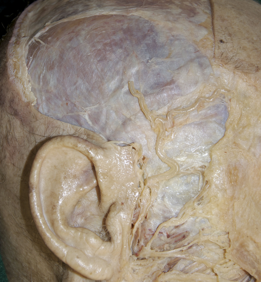 Temporalis Muscle and Fascia