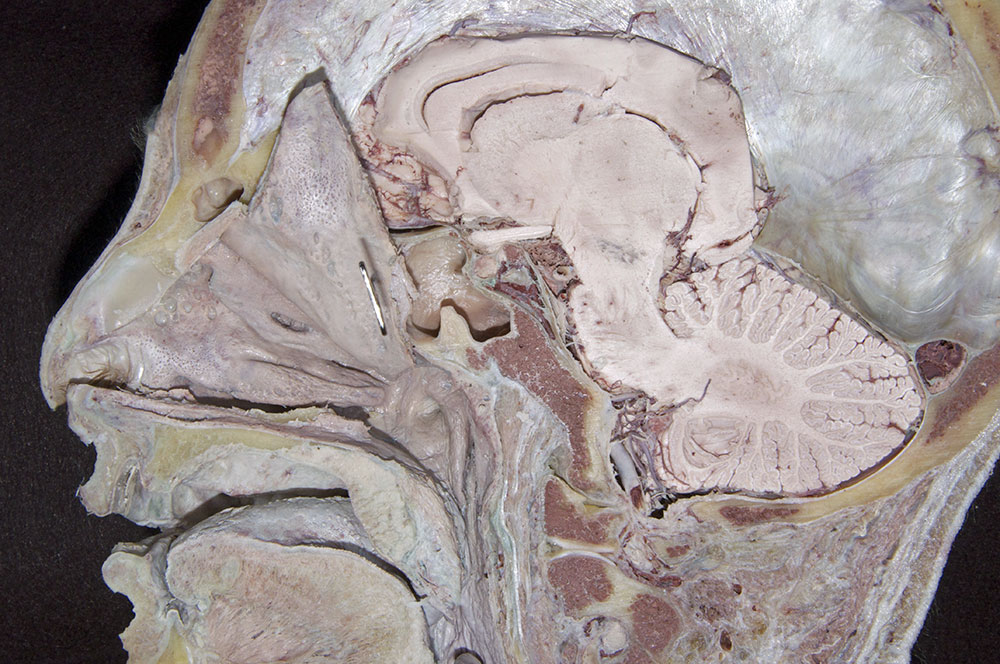 Reflected Nasal Septum