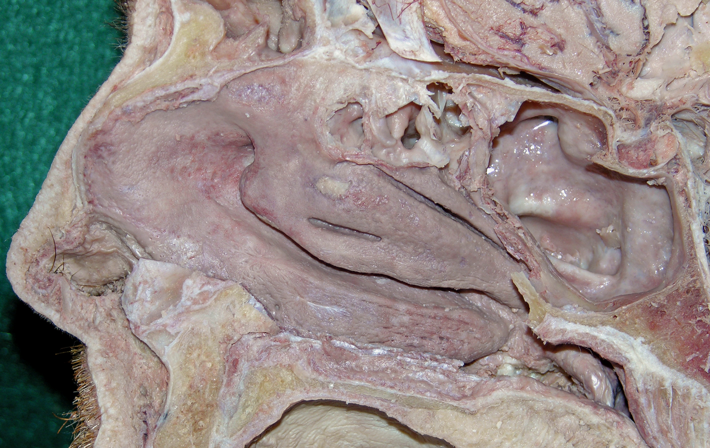 Lateral Wall (Nasal Cavity)
