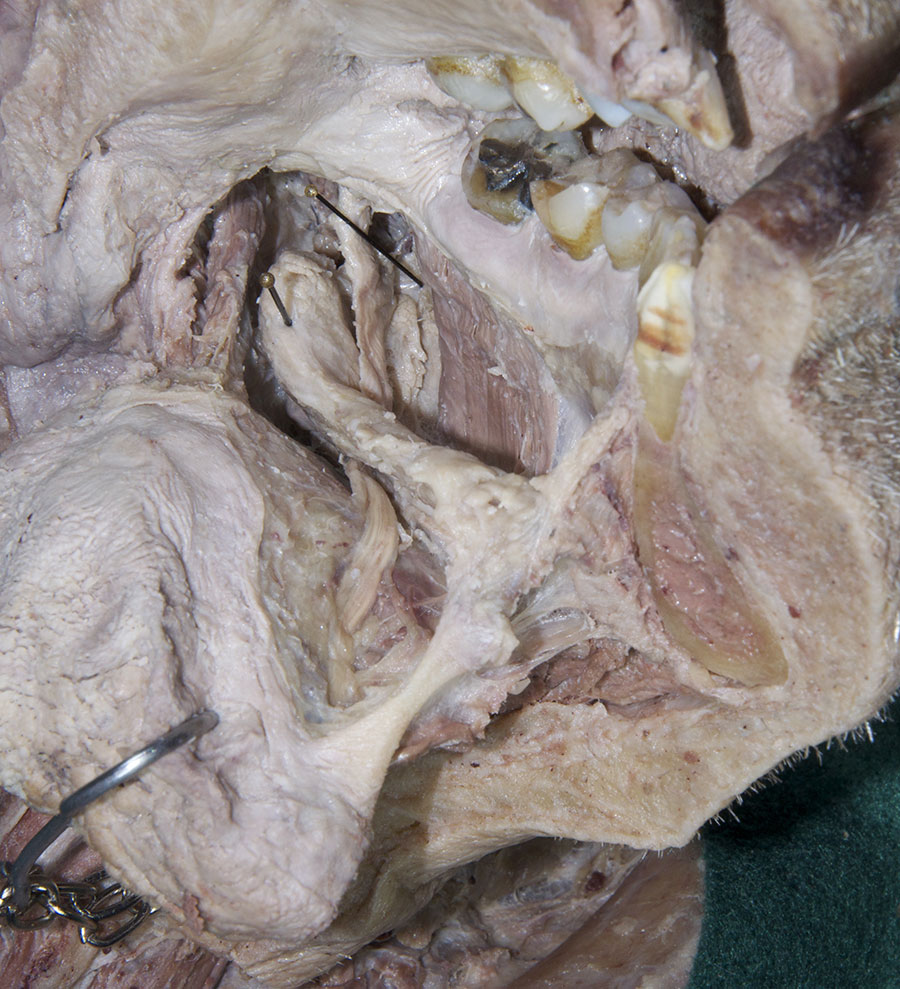 Lingual Nerve