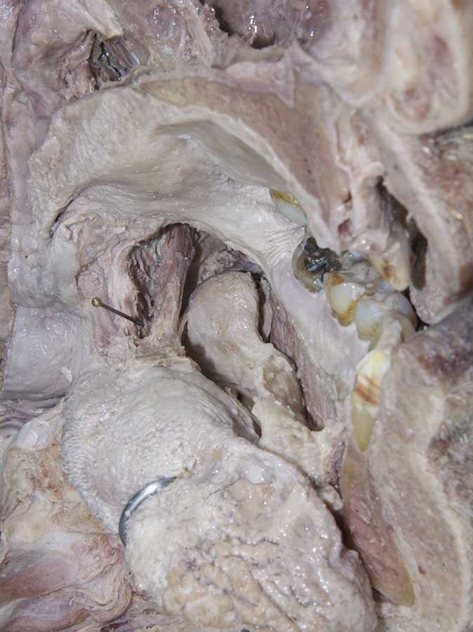 Right Styloglossus Muscle (Lateral Tongue)
