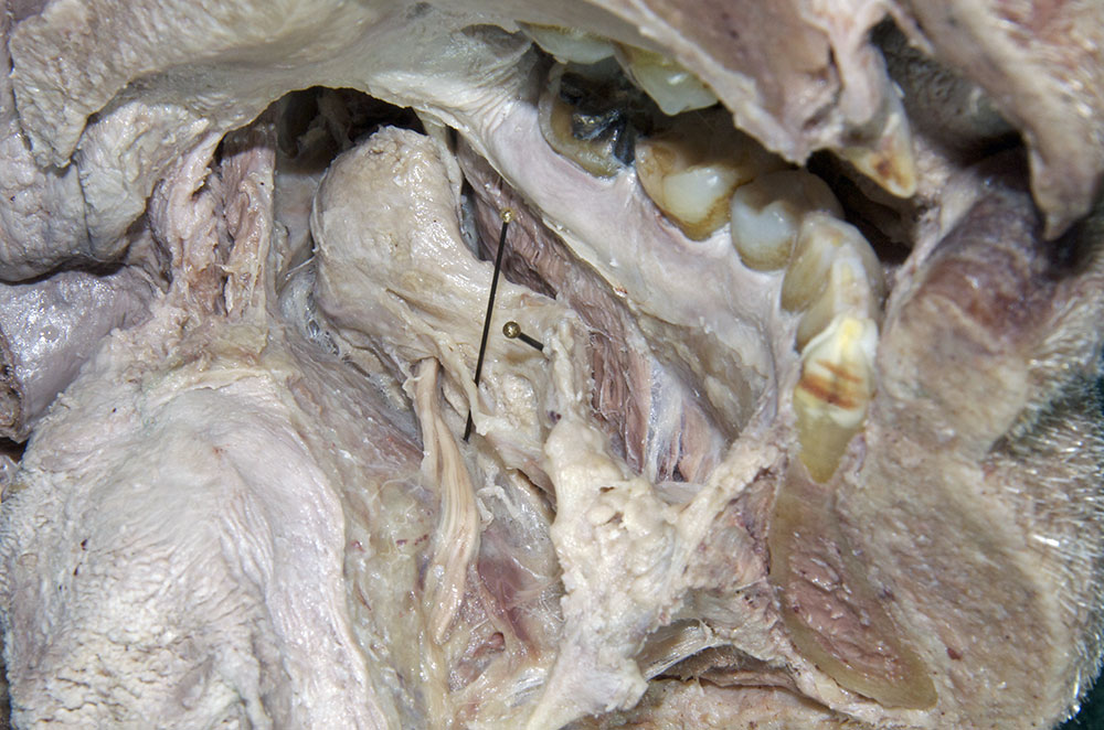 Submandibular Duct