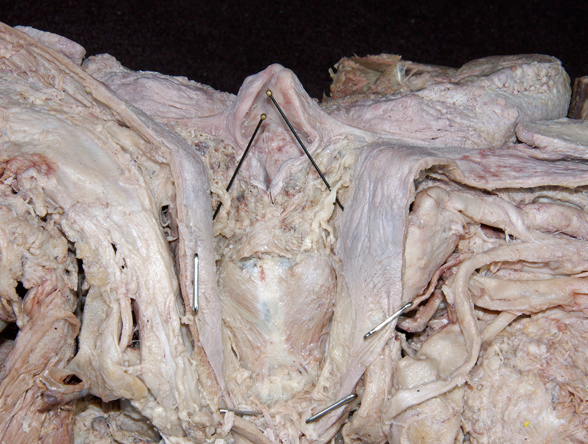 Internal Laryngeal Nerve in Piriform Recess