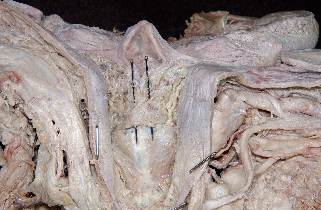 Arytenoid Muscles