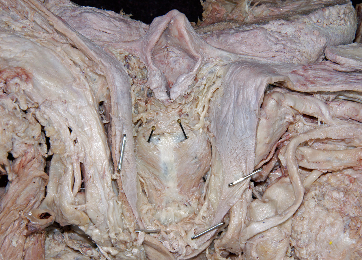 Posterior Cricoarytenoid Muscles