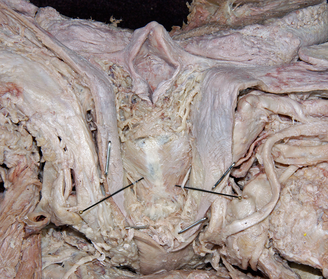 Recurrent Laryngeal Nerves