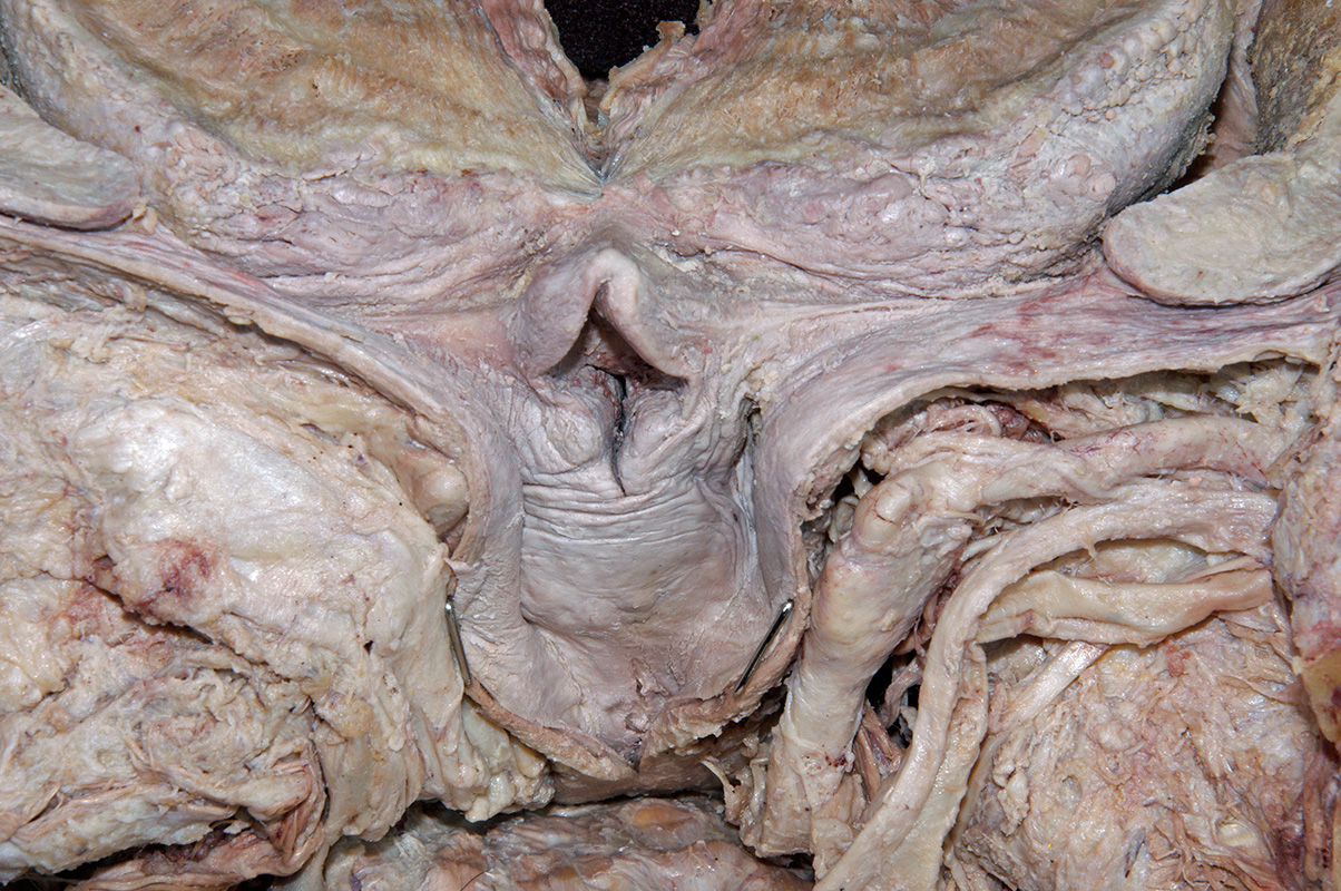 Piriform Recess