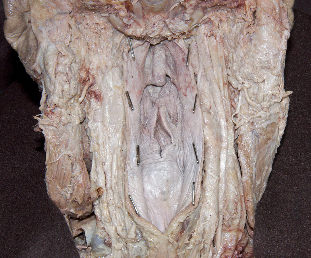 Reflected Pharyngeal Wall