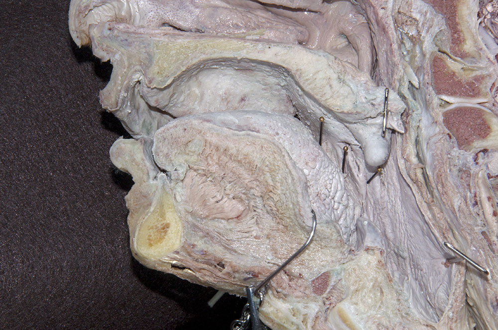 Tonsilar Bed