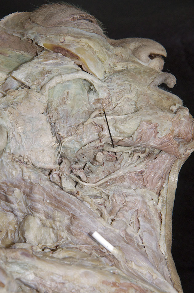 Lingual and Hypoglossal Nerves