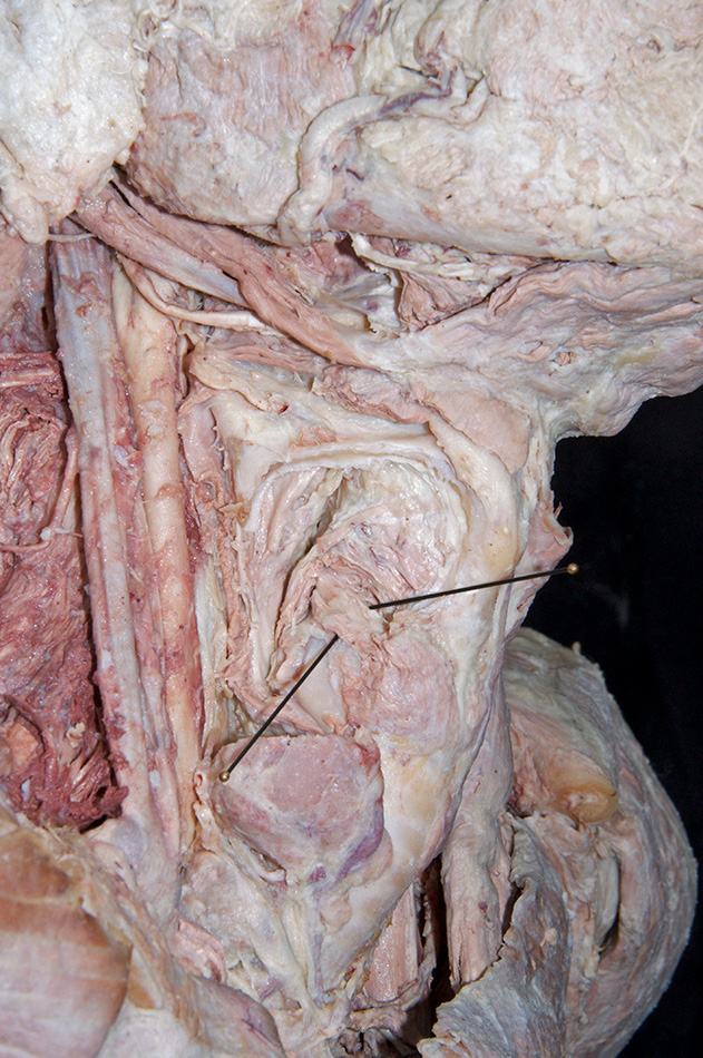 Lateral Cricoarytenoid Muscle