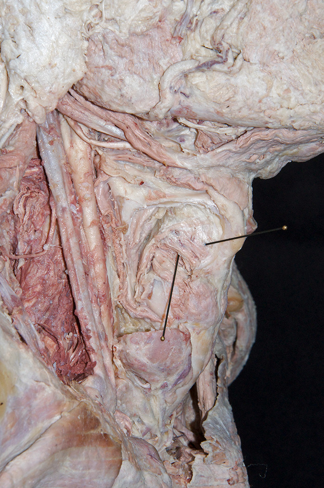 Thyroarytenoid Muscle