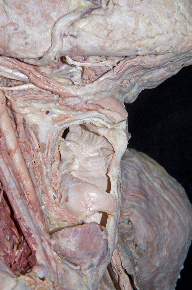 Vestibular Fold (with right thyroid cartilage lamina removed)