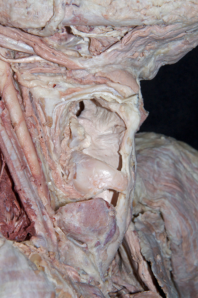Arytenoid Cartilage