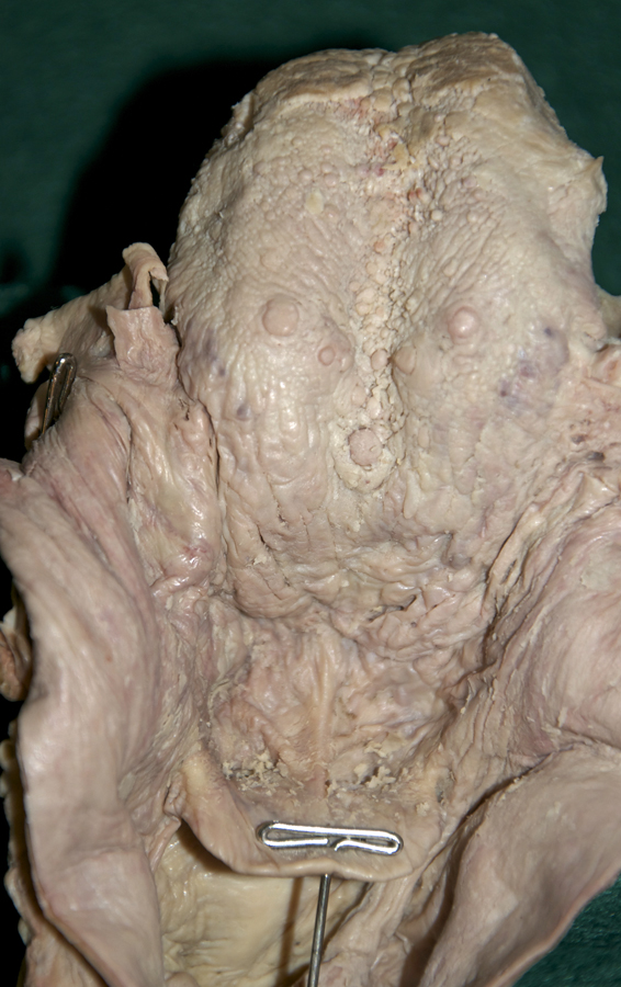 Posterior Tongue