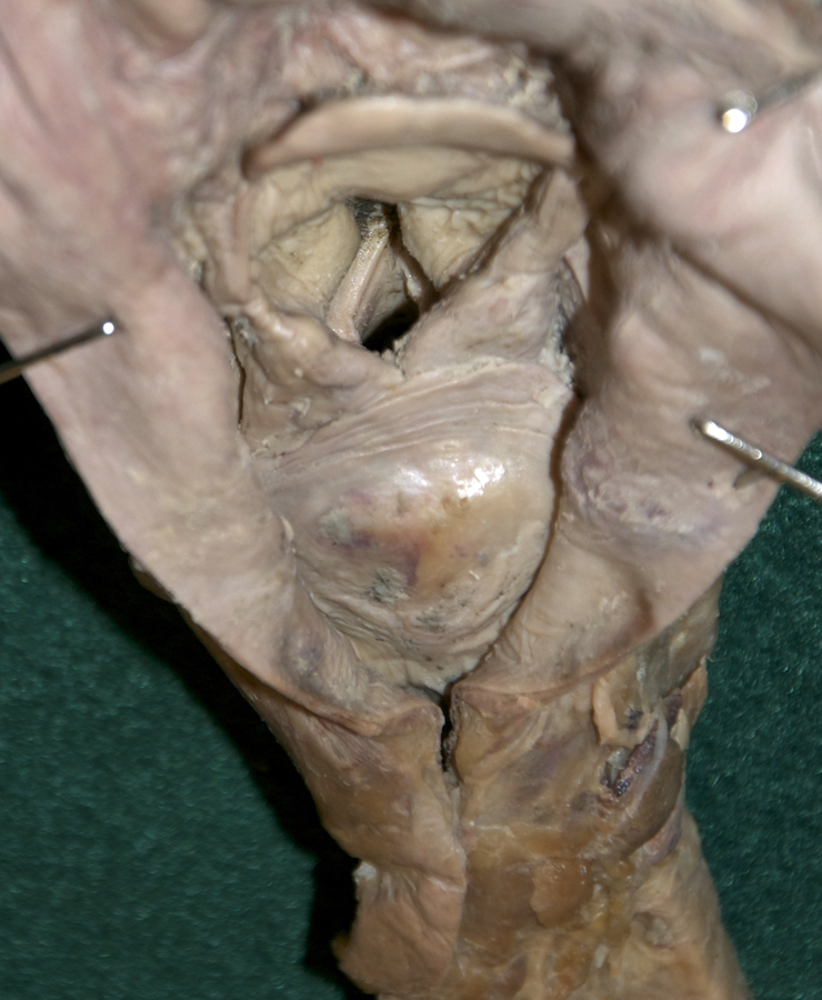 Vocal Folds