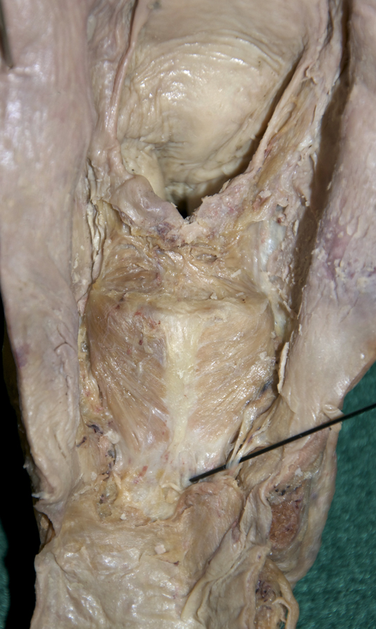 Aryepiglotticus Muscle