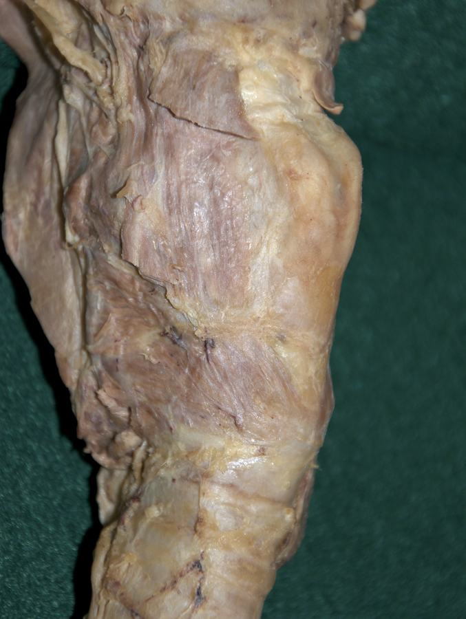 Right Cricothyroid Muscle