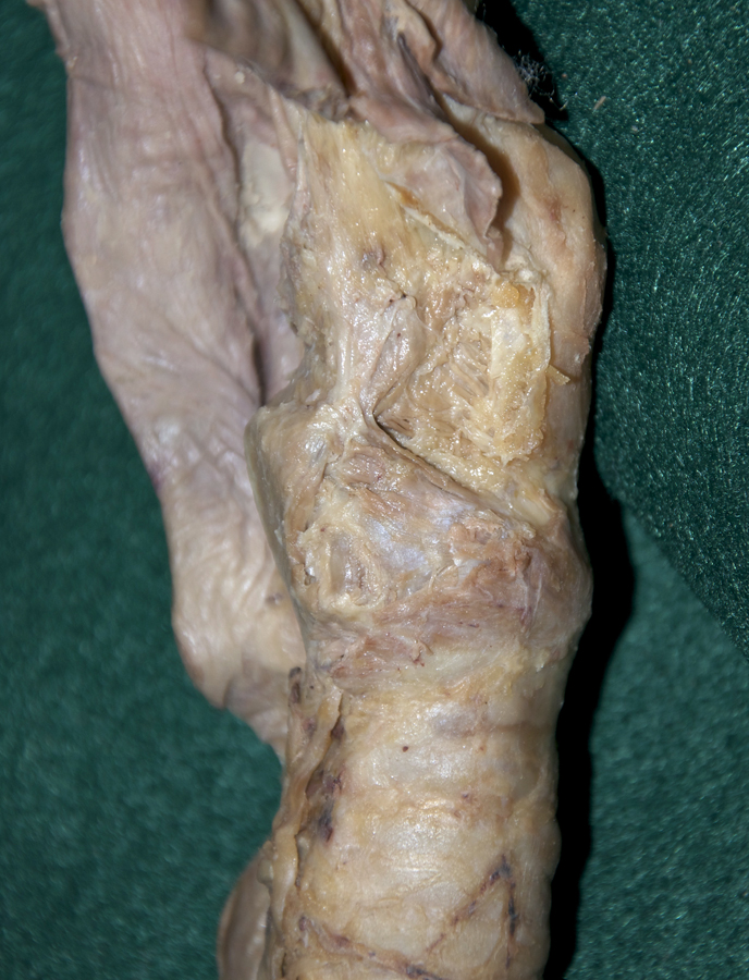 Lateral Cricoarytenoid Muscle (right thyroid lamina removed)
