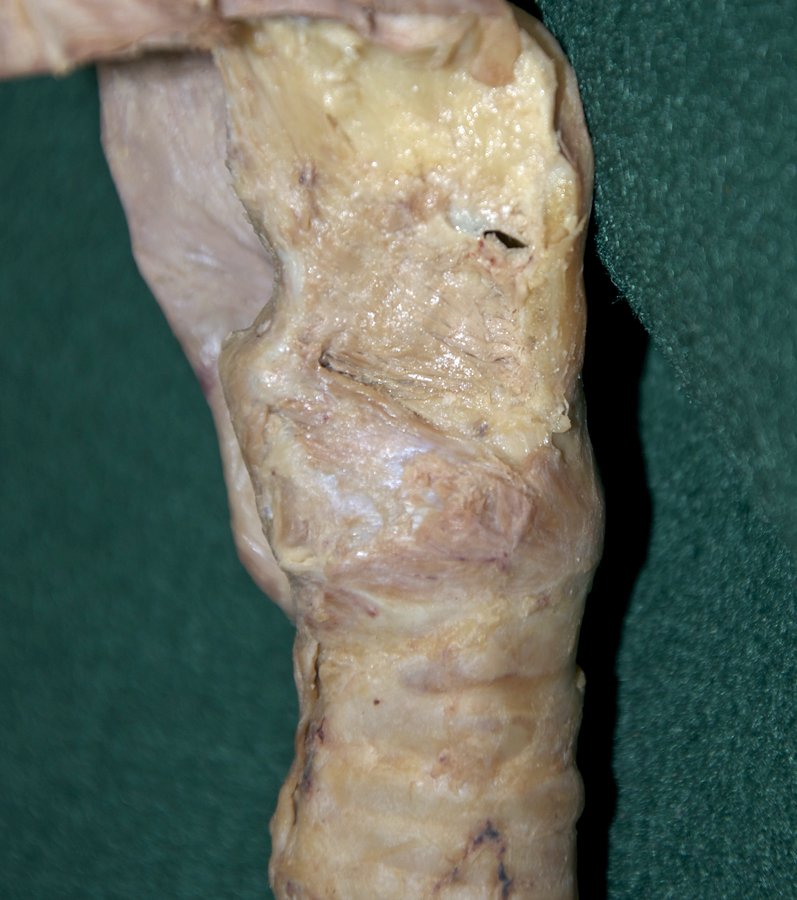 Thyroarytenoid Muscle