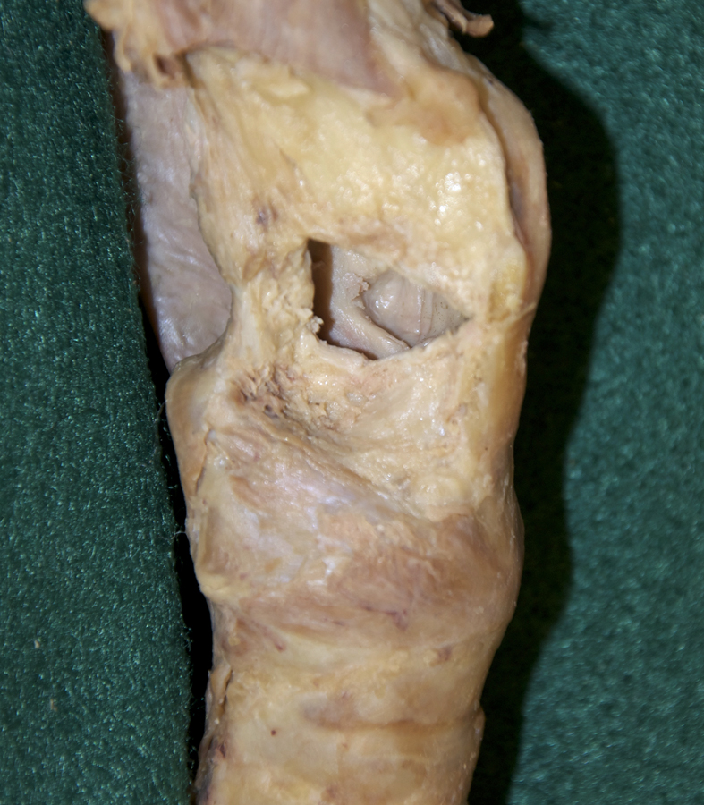 Vocal Ligament (Thyroarytenoid Muscle Removed)