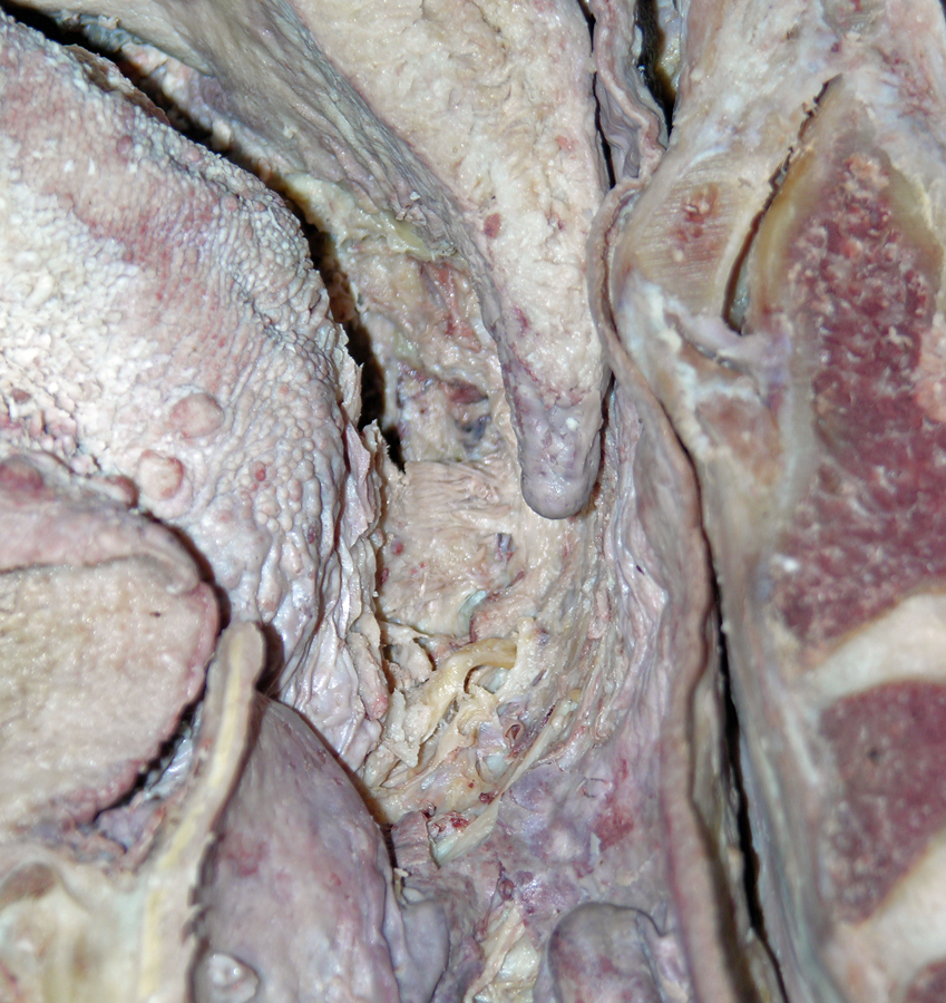 Right Styloglossus Muscle (Tonsilar Bed)