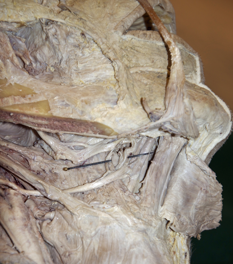 Right Lateral Tongue (Inferior View)