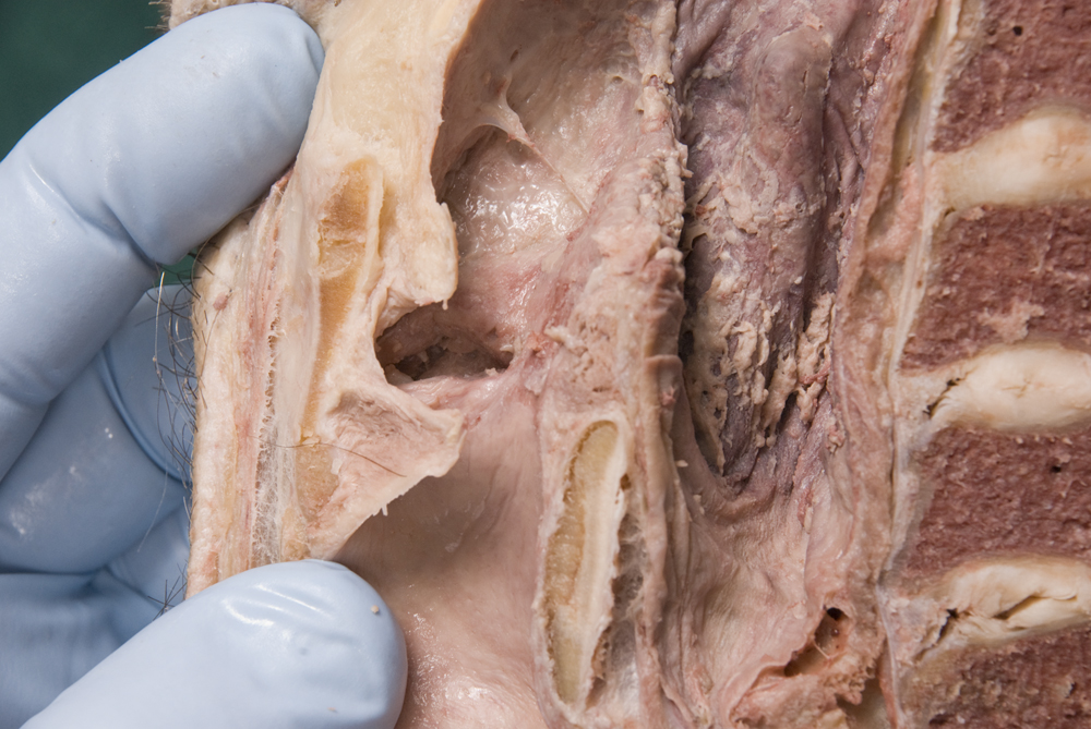 Right Vocal fold