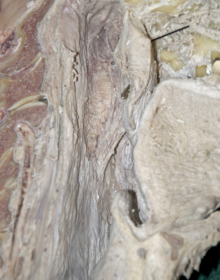 Palatopharyngeus Muscle