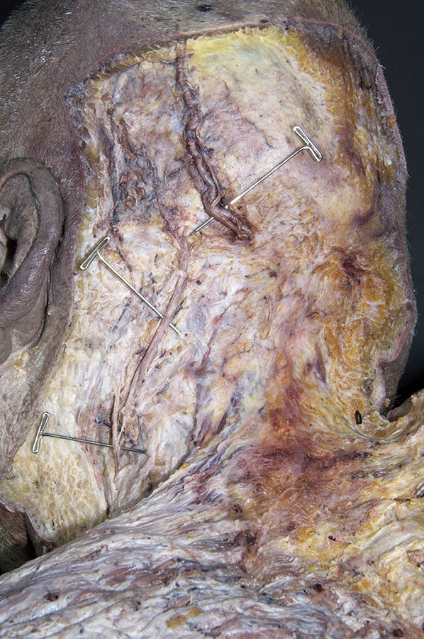 Greater Occipital Nerve