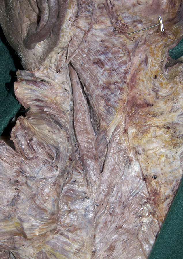 Levator Scapulae Muscle