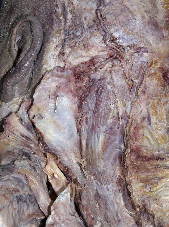 Semispinalis Capitis Muscle