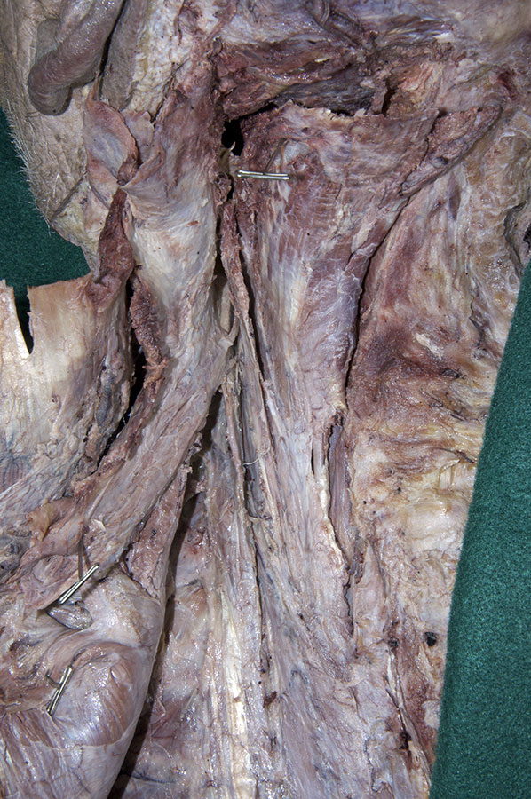 Longissimus Capitis Muscle