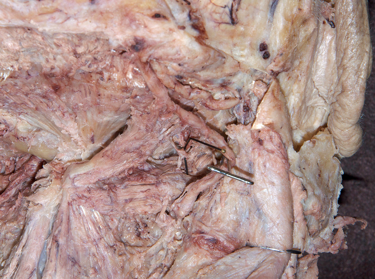 Right Suboccipital Nerve