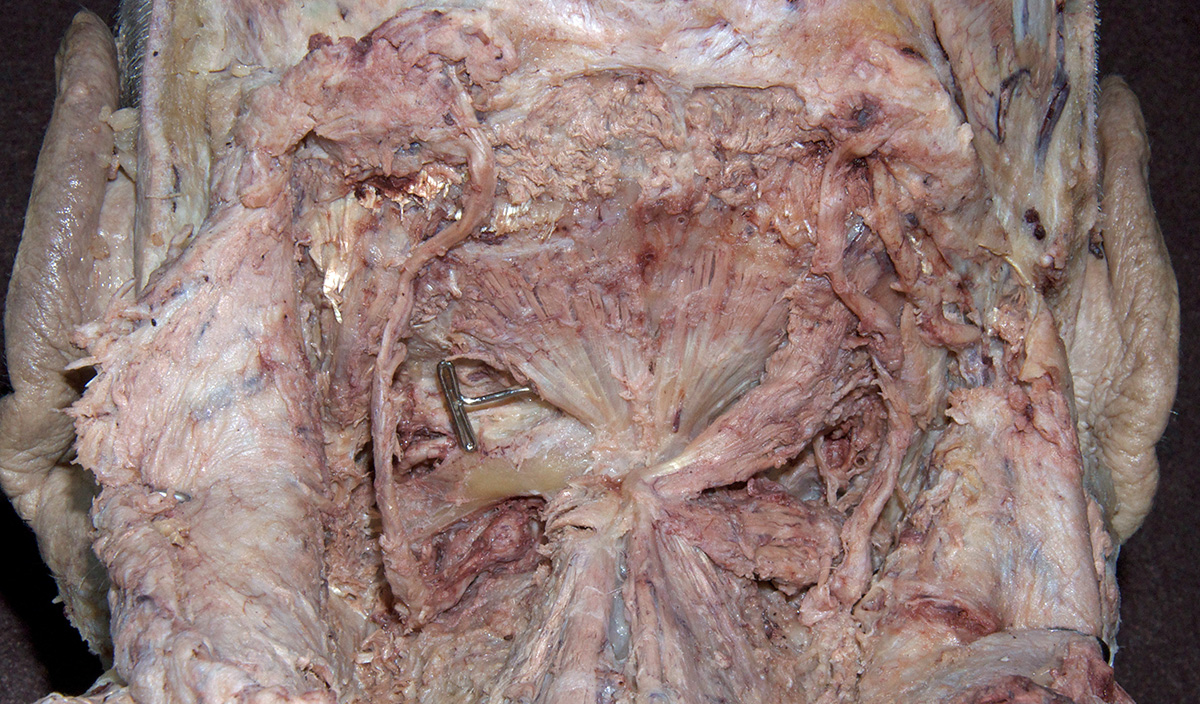 Rectus Capitis Posterior Minor Muscle