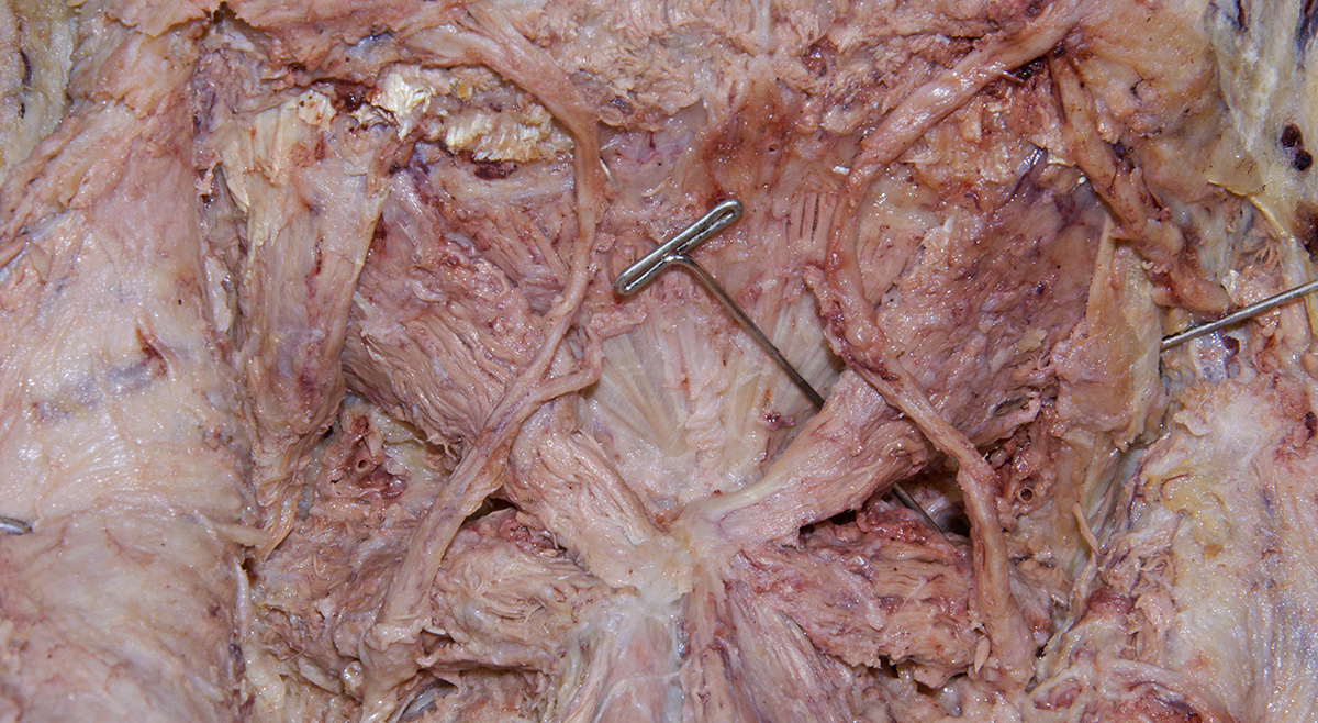 Inferior Oblique Muscle