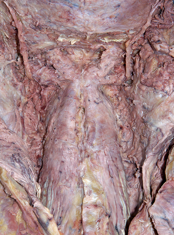Semispinalis Cervicis Muscle