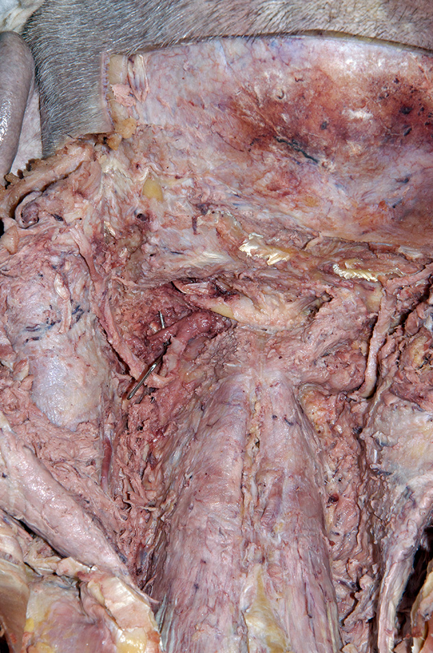 Left Dorsal Root Ganglion C2