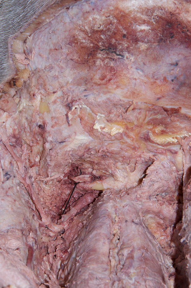Left Vertebral Artery