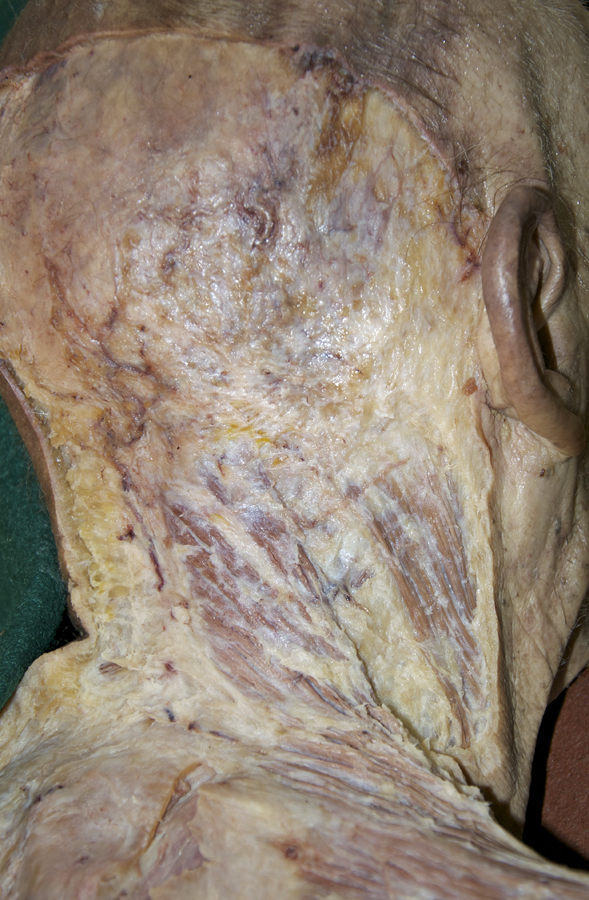 Upper Trapezius Muscle