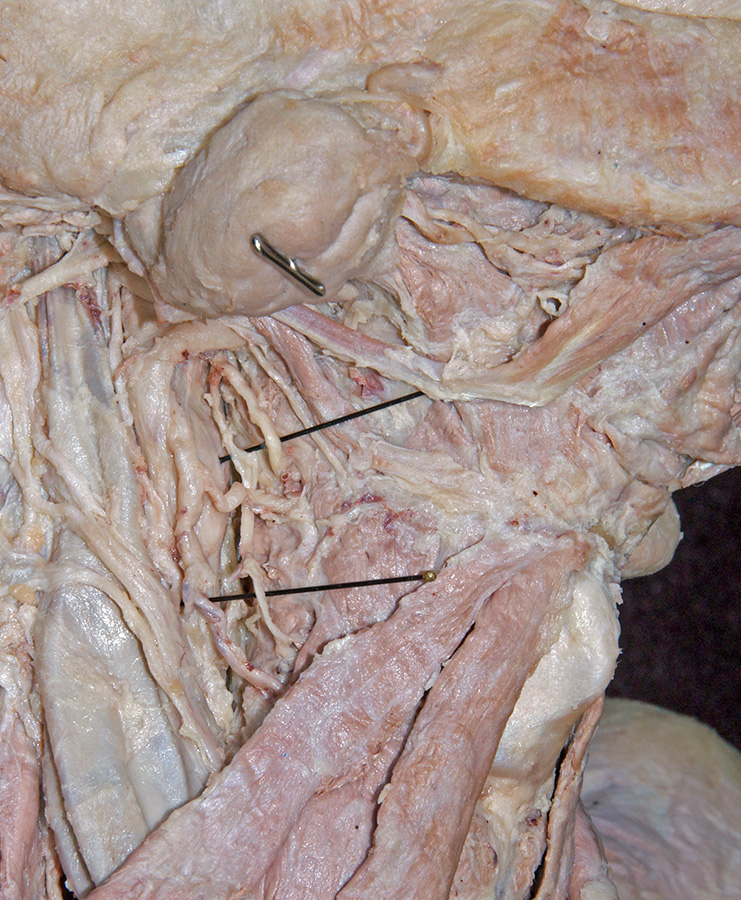 External Laryngeal Nerve