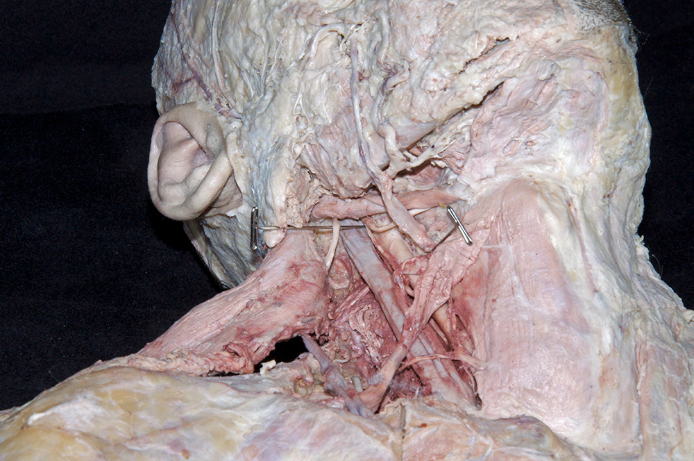 Sternocleidomastoid Muscle (reflected)