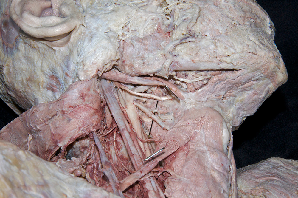 Superior Thyroid Artery