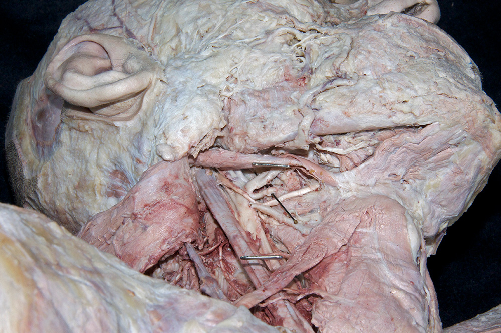 Facial Artery