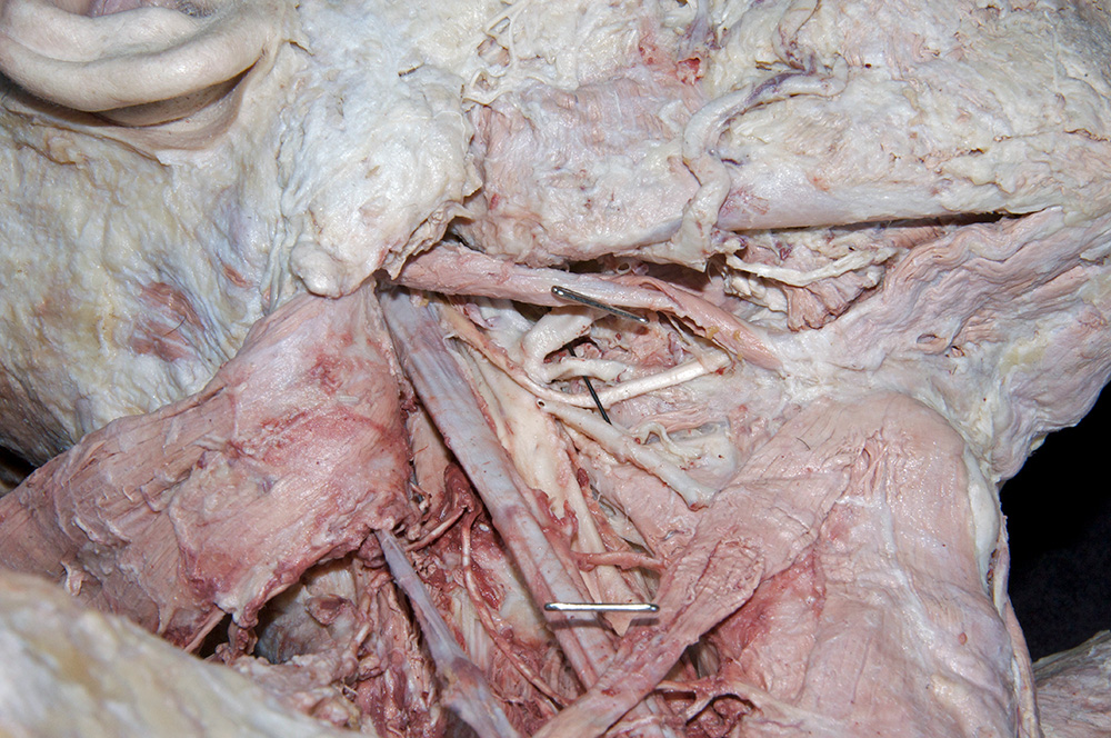 Lingual Artery
