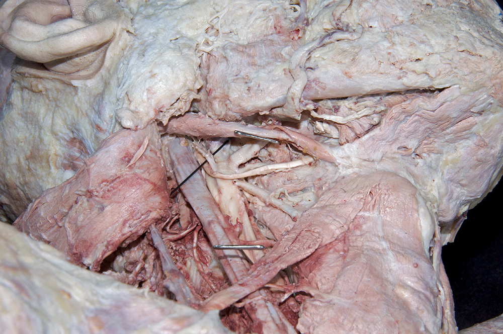 Occipital Artery