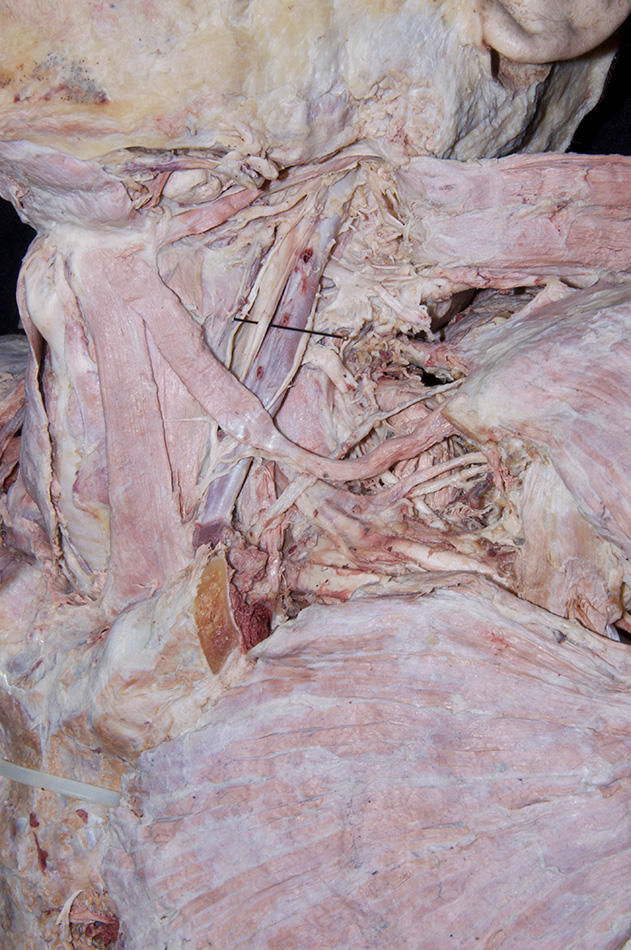 Vagus Nerve