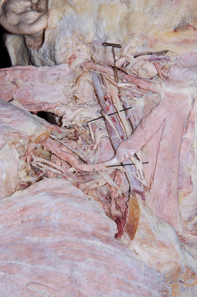Ansa Cervicalis