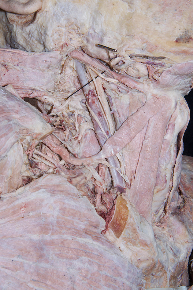 Hypoglossal Nerve