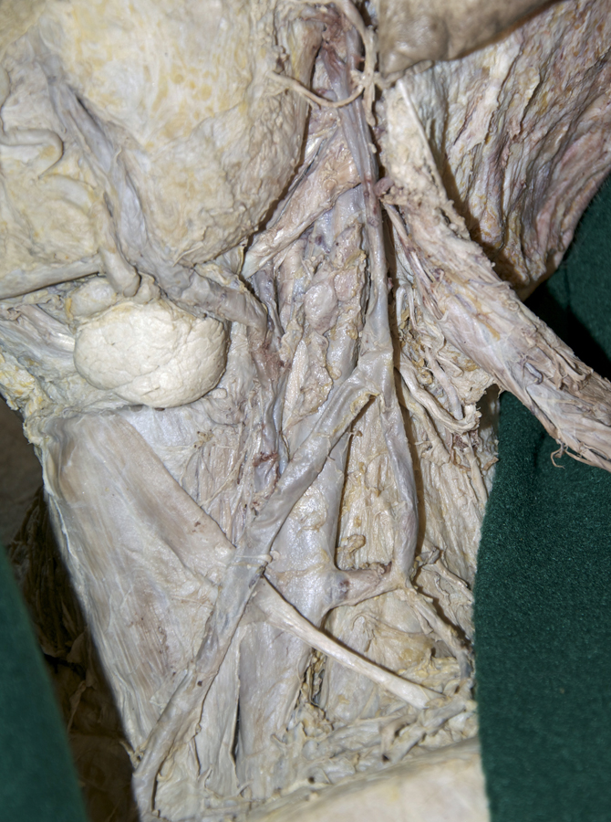 Left Deep Cervical Lymph Nodes